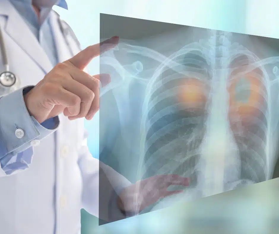 Doctor looking at lung X-ray to diagnose lung cancer - radon and lung cancer risk